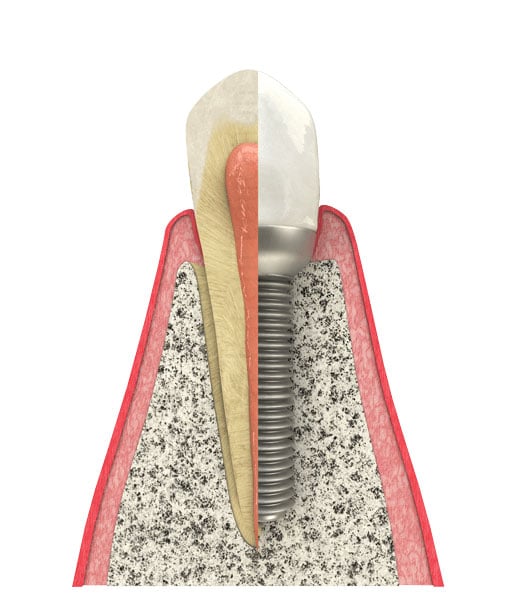 Benefits of Dental Implants in Leland, NC