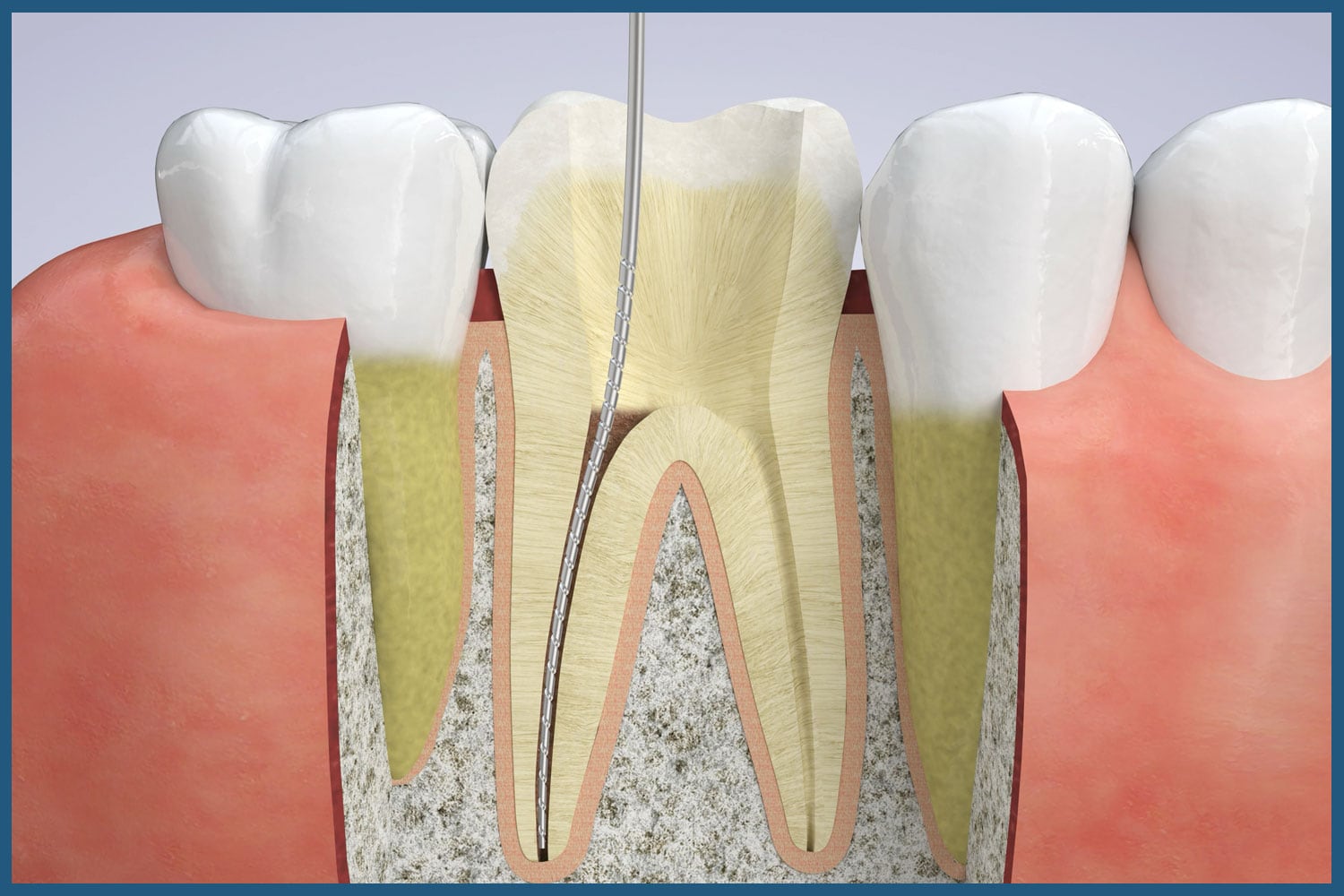 Root Canals Save Natural Tooth in Leland, NC BlueWave Dentistry