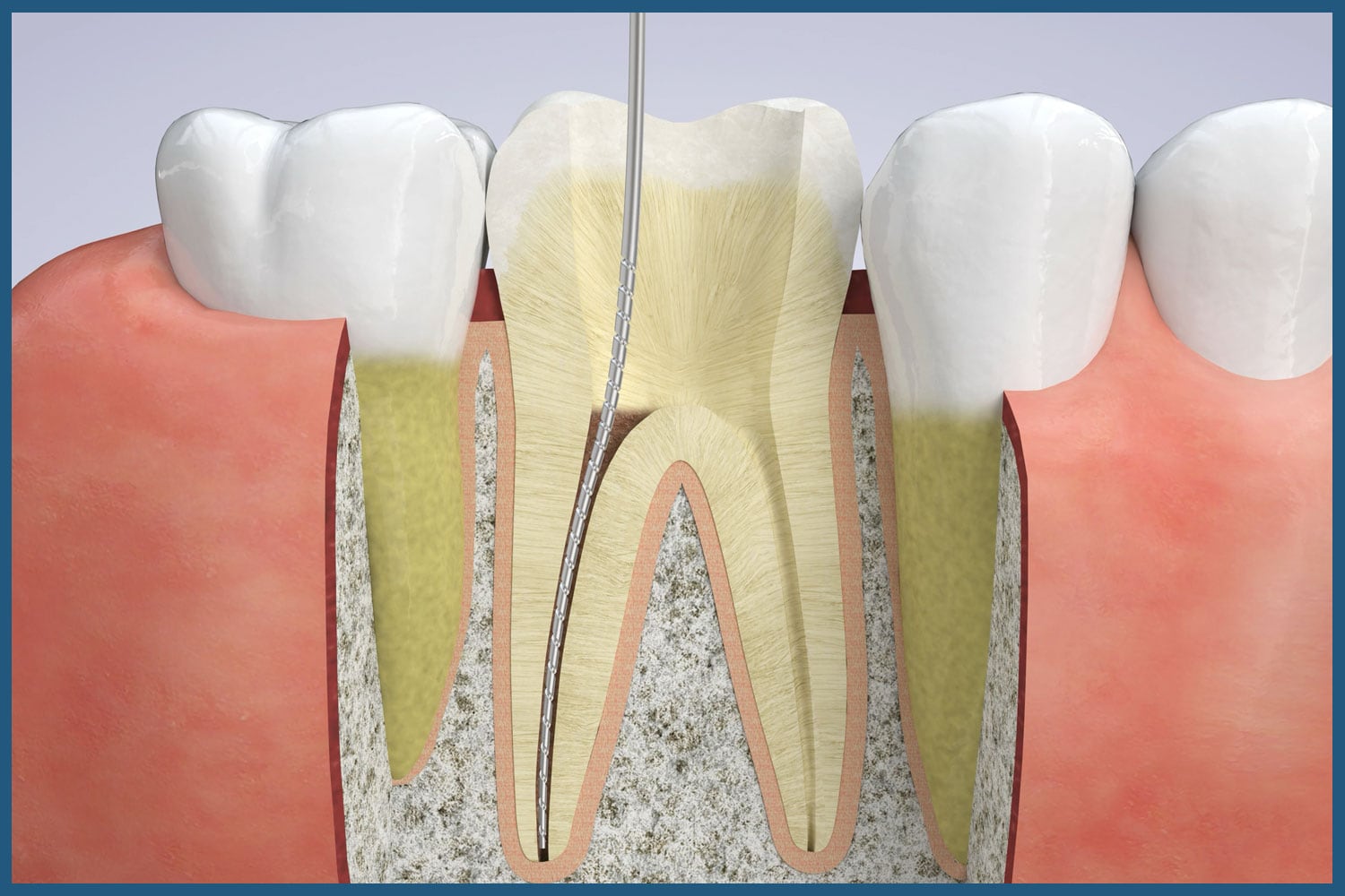 Stages of Root Canal Therapy in Leland, NC