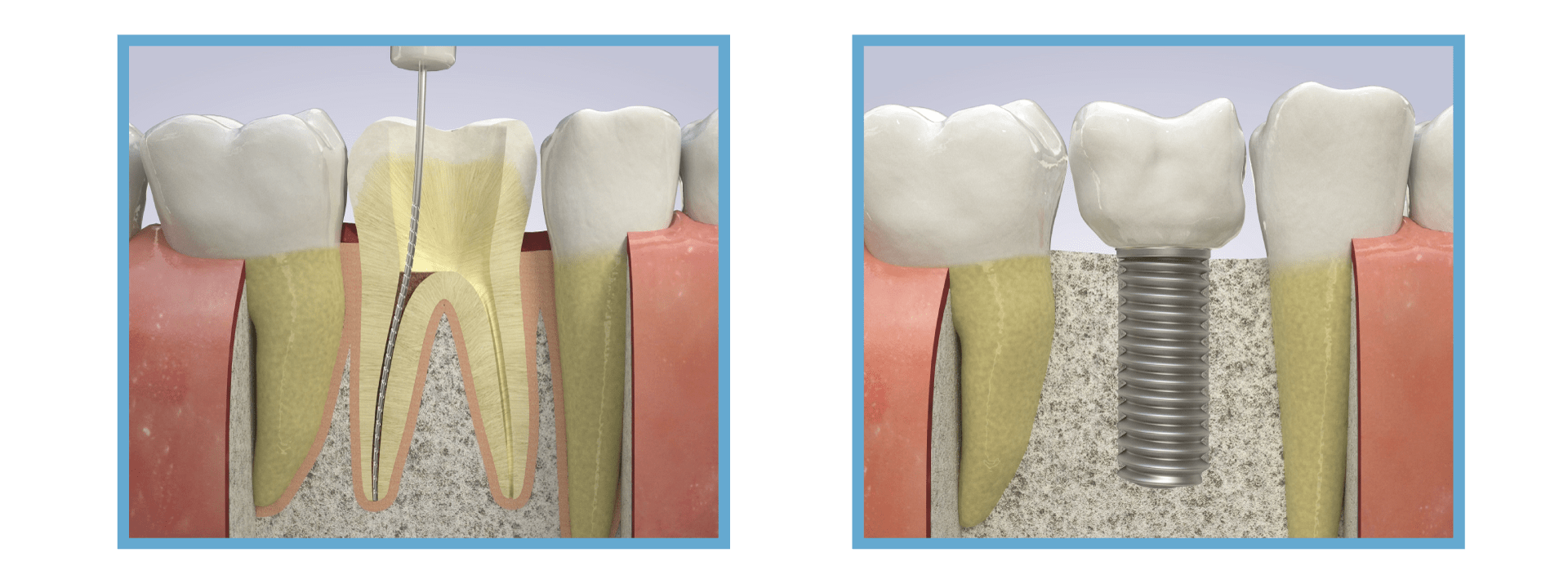 Root Canal vs. Dental Implant Procedure